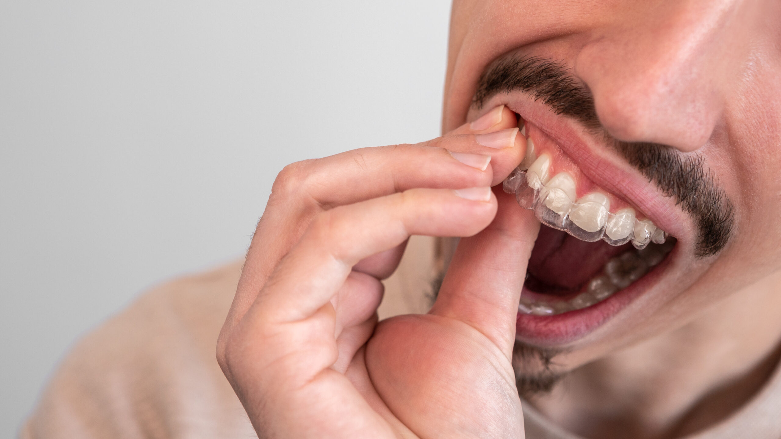 Mężczyzna zdejmujący nakładkę Invisalign z górnego łuku zębowego.